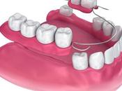 Types Dentures