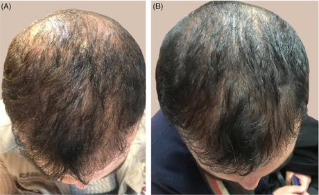 Minoxidil Market to Reach US$ 951.8 Million in 2020 and Witness High Growth Owing to Increasing Demand for Hair Loss Treatment Minoxidil Market to Reach US$ 951.8 Million in 2020 and Witness High Growth Owing to Increasing Demand for Hair Loss Treatment