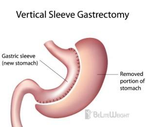 Best Gastric Sleeve Surgery for Weight Loss | BE LITE WEIGHT