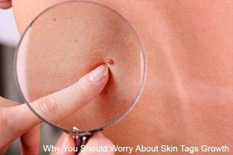 skin tag remover Cream
