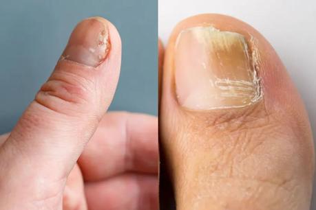 Nail Psoriasis: Causes, Symptoms, Prevention, Treatments, And Medication