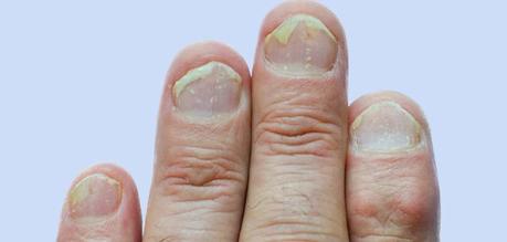 Nail Psoriasis: Causes, Symptoms, Prevention, Treatments, And Medication