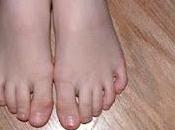 Years Toes