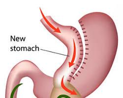 Best Gastric Bypass Surgery in USA, California, CA