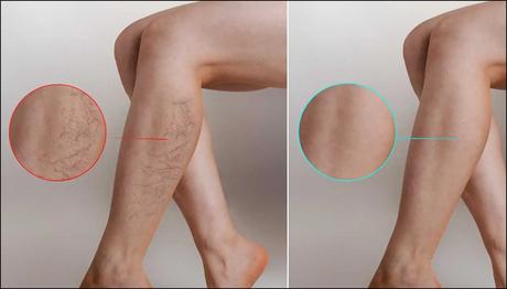 What is Spider Veins(Telangiectasias)? – Causes, Symptoms, and Ayurvedic Treatment