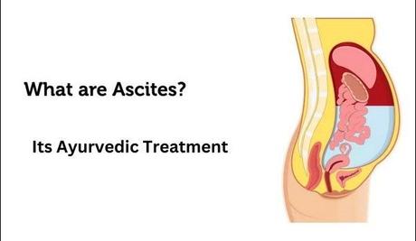 Ascites Causes, Symptoms,  and Ayurvedic Treatment