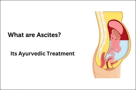 Ascites Causes, Symptoms,  and Ayurvedic Treatment