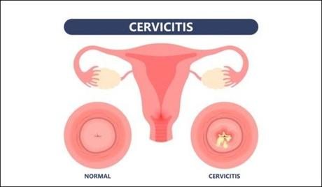Cervicitis Causes, Symptoms and Herbal Treatment