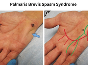 Palmaris Brevis Spasm Syndrome Treatment Ayurveda