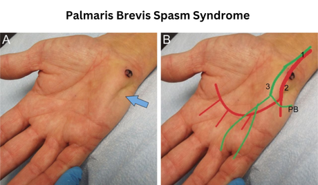 Palmaris Brevis Spasm Syndrome Treatment In Ayurveda