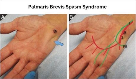 Palmaris Brevis Spasm Syndrome Treatment In Ayurveda