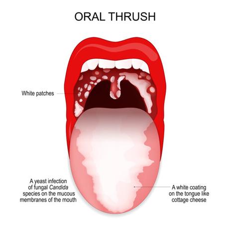 Oral Thrush