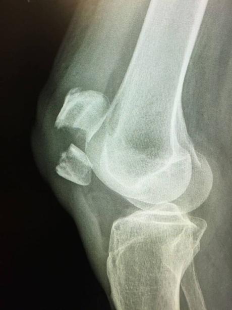 Kneecap Fractures (Patella Fractures) - Paperblog