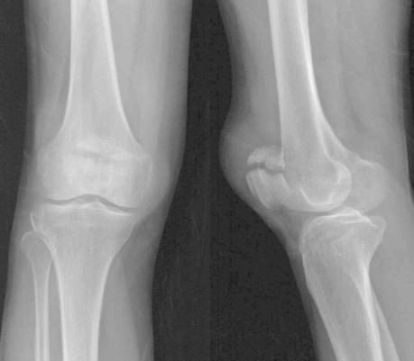 Kneecap Fractures (Patella Fractures) - Paperblog