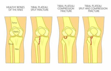 Kneecap Fractures (Patella Fractures) 11 Kneecap Fractures2