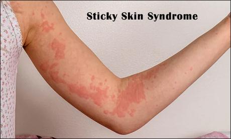Alternative Treatment For Sticky Skin Syndrome With Herbal Remedies