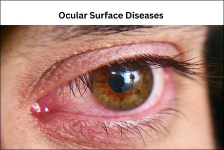 Ocular Surface Diseases Causes, Symptoms, And Ayurvedic Treatment