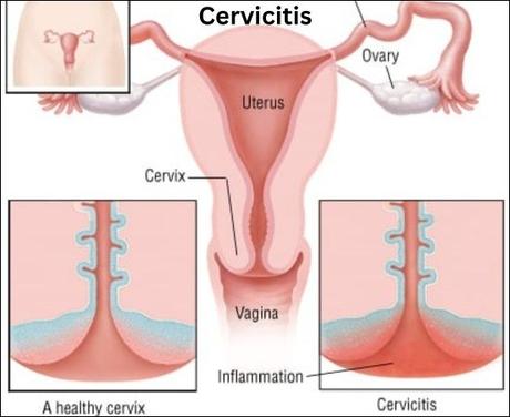 Cervicitis- Ayurvedic View And Herbal Treatments