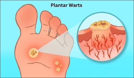 Plantar Warts Causes, Symptoms, and Ayurvedic Treatment