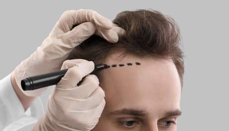 Application Of Hbot in Hair Transplant