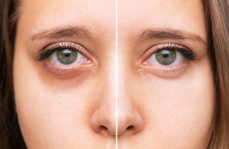 4 Minimally Invasive Treatments for Dark Circles Under Eyes