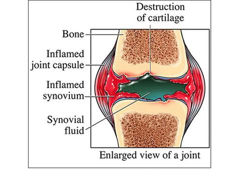 Natural treatment for Rheumatoid Arthritis