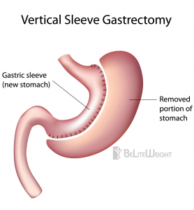 Best Gastric Sleeve Revision in USA, California