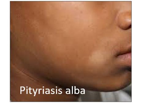 Ayurvedic Treatment For Pityriasis Alba with Herbal Remedies