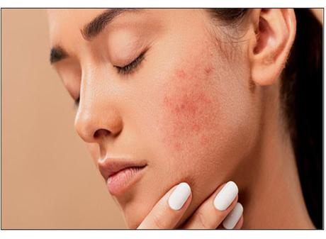 Natural Treatment For Acne With Herbal Remedies