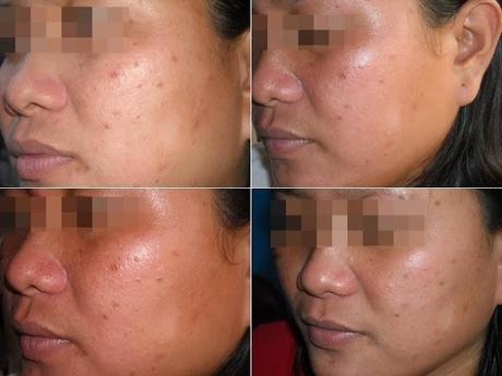 DermXpert 6-Days Total Skin Renewal Treatment