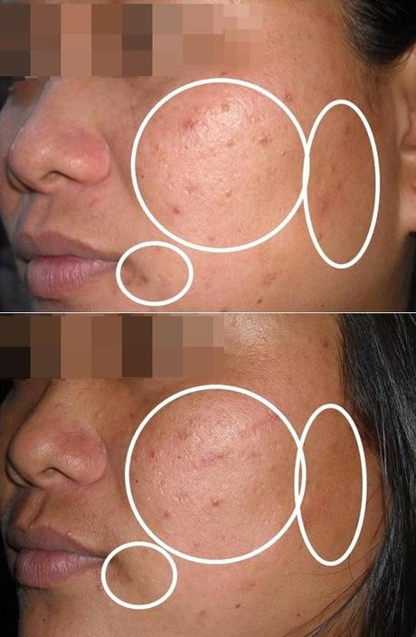 DermXpert 6-Days Total Skin Renewal Treatment