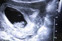 Pregnancy/Abortion