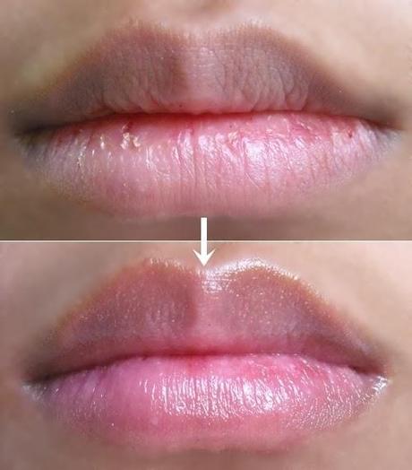 Softer Lips in a few minutes – Brilliant Loveheart Lip Care System