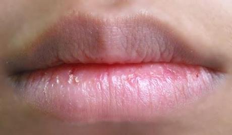 Softer Lips in a few minutes – Brilliant Loveheart Lip Care System