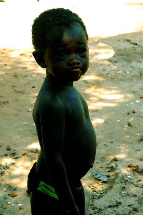 Remember The Darkest Child Who Was Abandoned? See His Current Photos