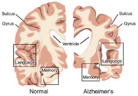 normal vs Alzehimer's brain