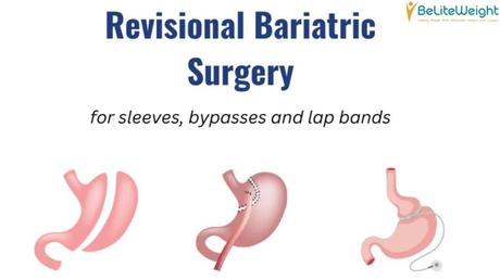 Bariatric Revision Surgery: Getting a Second Chance at Weight Loss