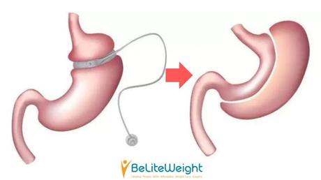 Bariatric Revision Surgery: Getting a Second Chance at Weight Loss