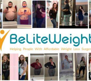 750+ Gastric Bypass Before and After | Pictures & Stories