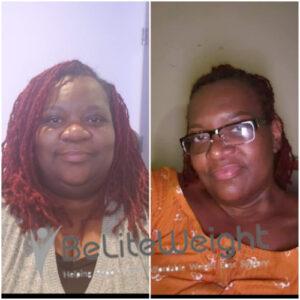 750+ Gastric Bypass Before and After | Pictures & Stories