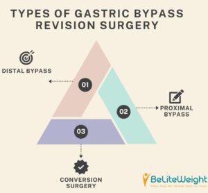 Second Chance for Weight Loss: Gastric Bypass Revision