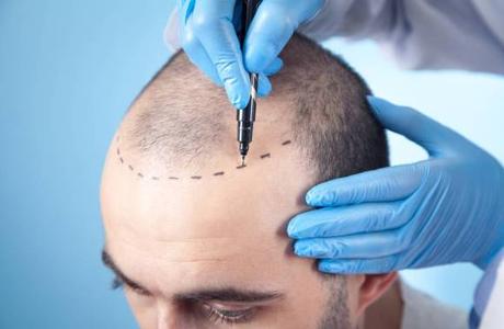 Surgical vs. Non-Surgical Hair Replacement: What Is the Best Hair Replacement Method for You?