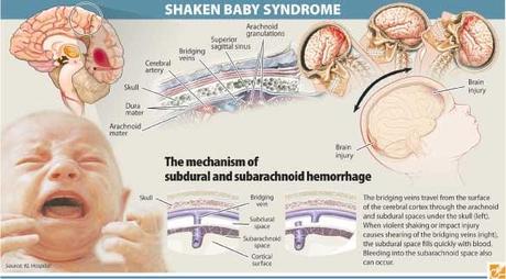 Shaken Baby Syndrome