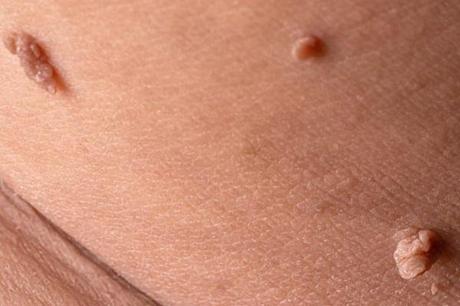 Ten Facts About Skin Tags You Can't Remove From The Truth