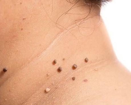 Ten Facts About Skin Tags You Can't Remove From The Truth