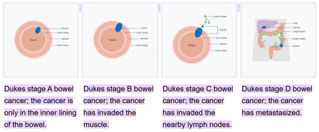 Colorectal carcinoma – Duke Staging and Management
