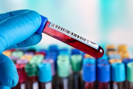 Blood Test Beats Doctors for Early Diagnosis of Alzheimer’s Disease
