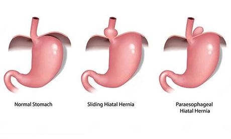 Hiatal Hernia Types, Symptoms, and Prevention