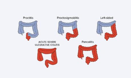 What is Ulcerative Colitis?