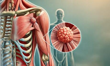 Sarcoma Symptoms, Types, Causes, and Treatments